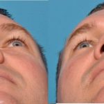 درمان انحراف بینی بدون جراحی