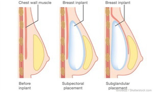 جراحی سینه زنان