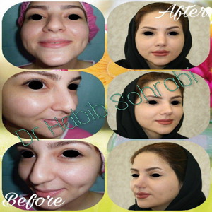قبل و بعد از عمل بینی غضروفی