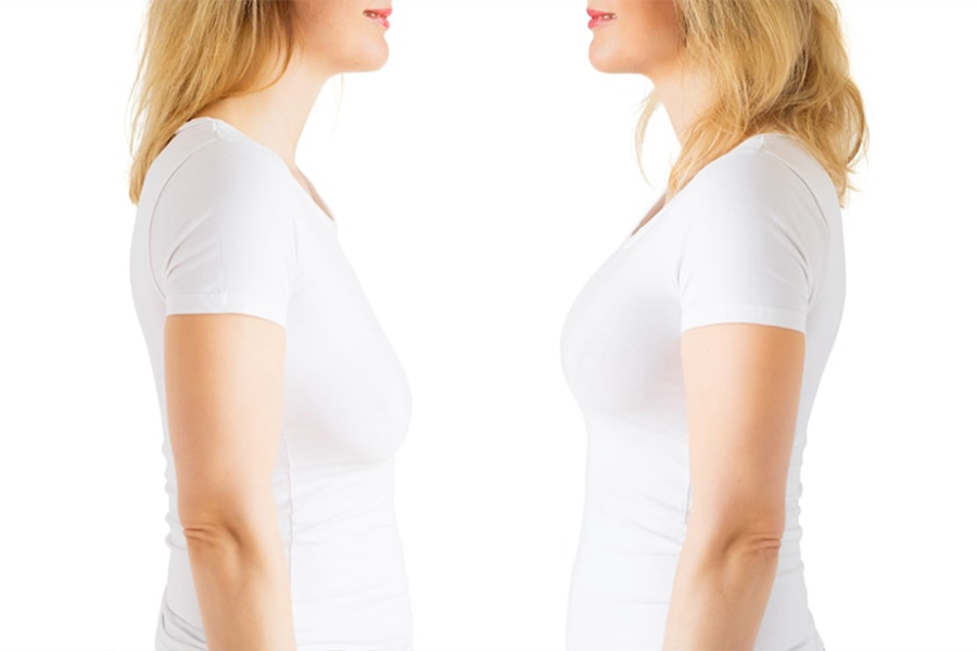 جراحی زیبایی سینه یا ماموپلاستی چیست؟